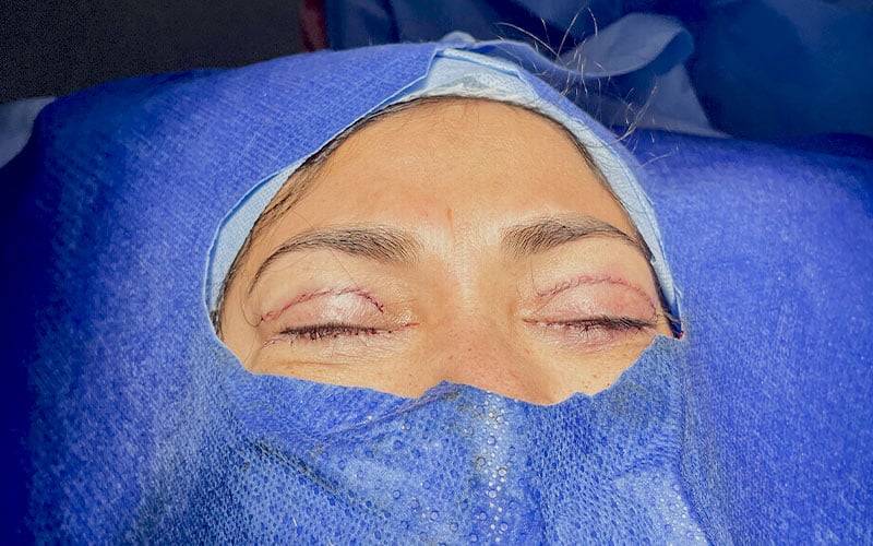 blefaroplastia-dra-rojas