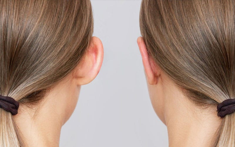 otoplastia-rojas